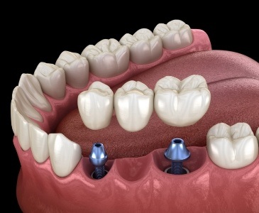 Animated dental implant bridge