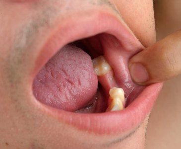 Close up of person stretching their lip to reveal missing tooth