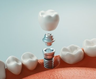 Animated dental implant abutment and crown