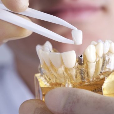 Dentist placing a dental crown on a dental implant model