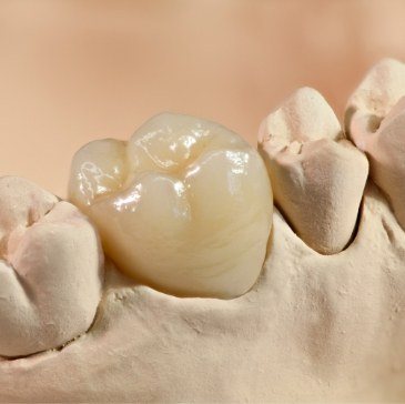 Dental crown resting atop tooth in model of the mouth