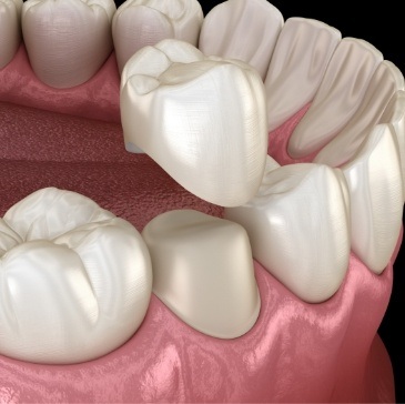 Animated dental crown being placed over a tooth