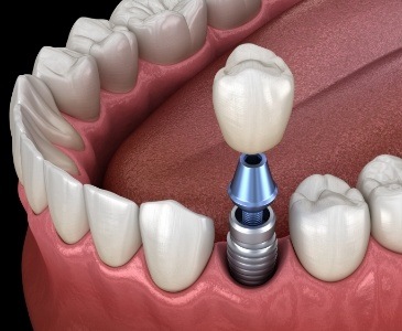 Animated dental implant with dental crown