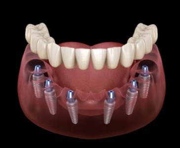 Animated implant denture