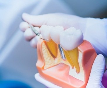 Dentist holding a dental implant model