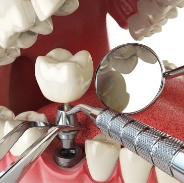 Animated dental implant being placed in the mouth