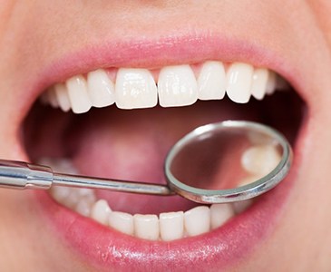 Teeth examined with dental mirror