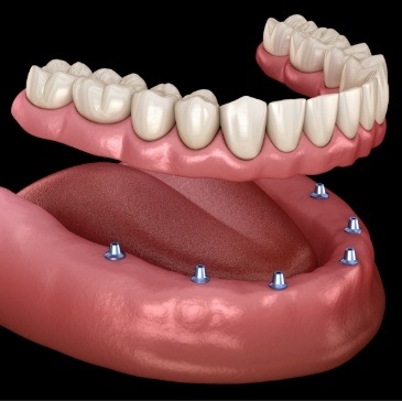 Animated implant denture being placed over six dental implants