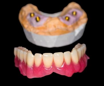 Model of removable implant denture