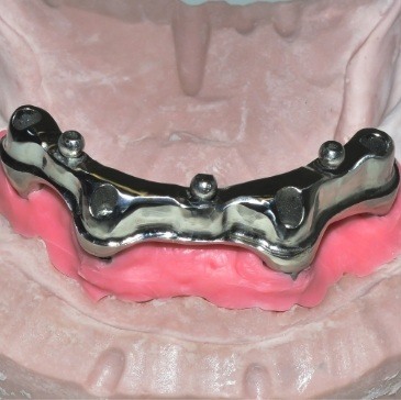 Model of jaw with implant denture