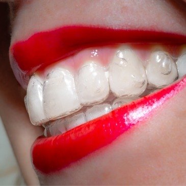Close up of smile with Invisalign aligner over the teeth