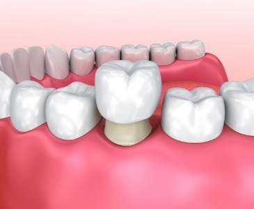 Animated dental crown being placed over a tooth