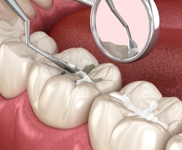 Animated filling being placed in a tooth
