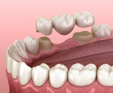 Animated dental bridge replacing a missing tooth