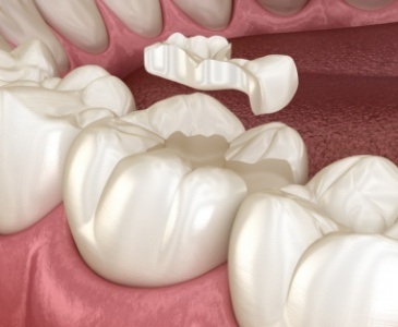 Animated dental inlay being placed on a tooth