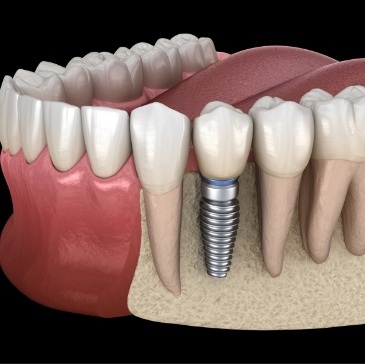Animated dental implant replacing a missing tooth