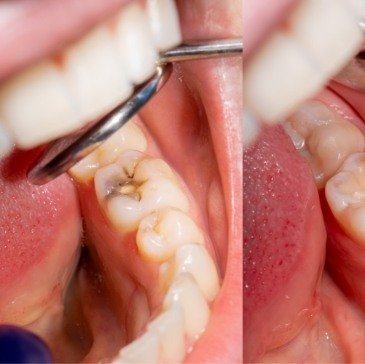 Close up of mouth during oral cancer screening