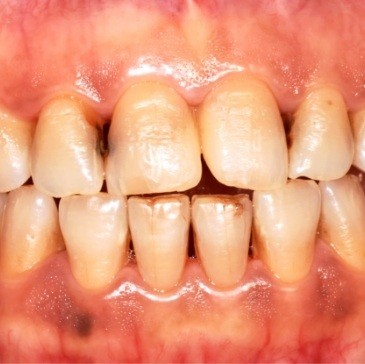 Close up of mouth with discolored and decayed teeth