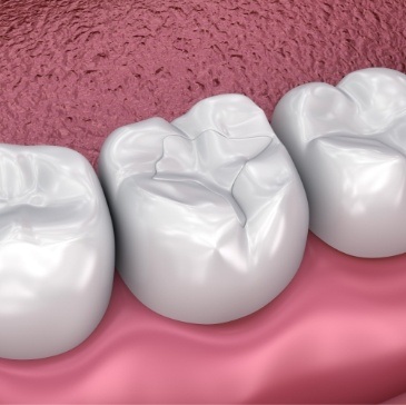 Animated row of teeth with dental sealants