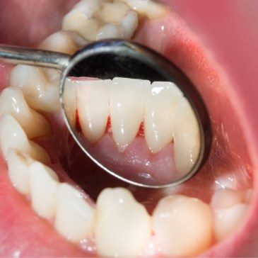 Close up of dental mirror inside of mouth