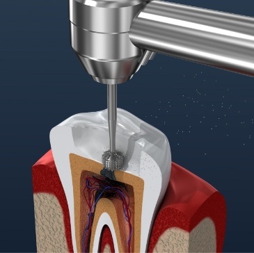 Animated dental instrument performing root canal treatment