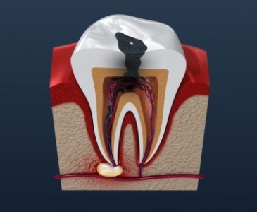 Animated damaged tooth that needs root canal treatment