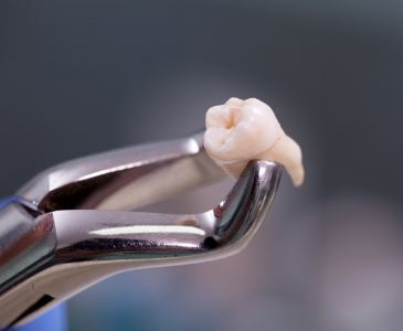 Dental forceps holding an extracted tooth