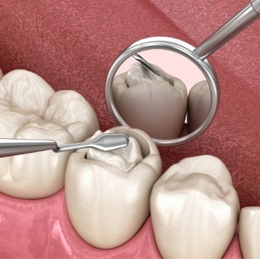 Animated tooth colored filling being placed in a tooth