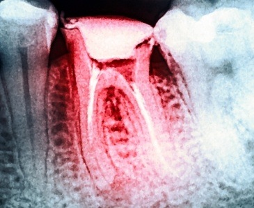 X ray of tooth highlighted red