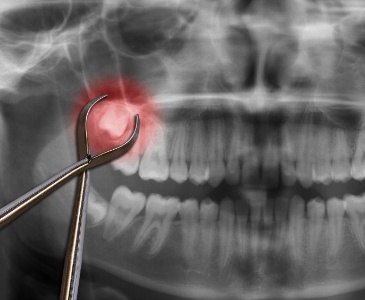 Dental x ray with impacted wisdom tooth highlighted red