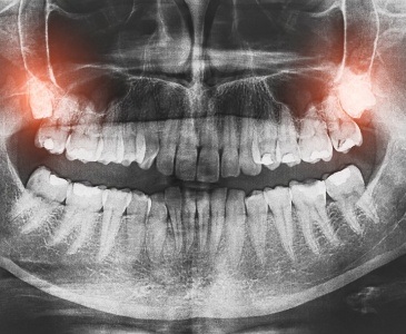 Dental x ray with locations of two impacted wisdom teeth highlighted red