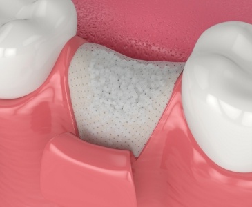 Animated dental bone grafting material being placed in jawbone after tooth extraction