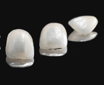 Three dental veneers against black background