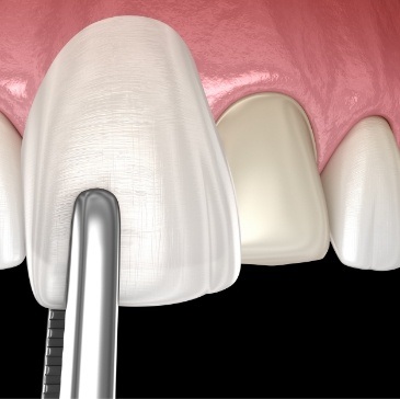 Animated veneer being placed over a tooth