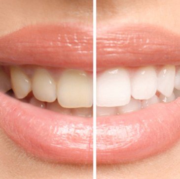 Teeth whitening before and after