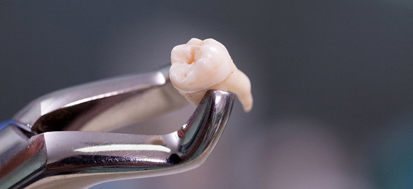 Large extracted tooth held by forceps