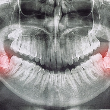 X-ray with lower wisdom teeth highlighted red