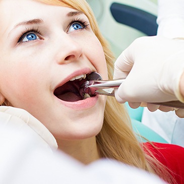 Dentist grasping woman’s molar with forceps