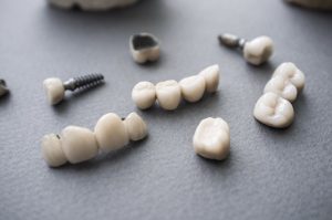 A collection of crowns, bridges, and implants.