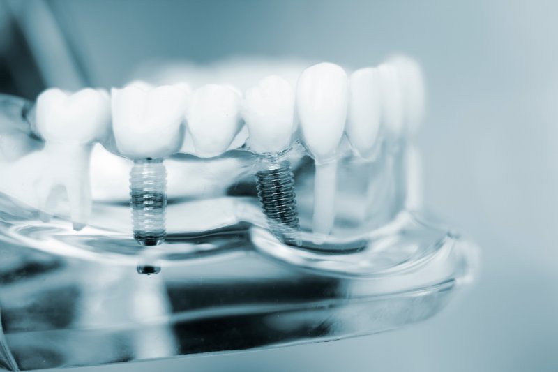 Dental implants stored in a mock jaw