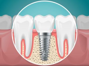 dental implant replacing missing bottom tooth 