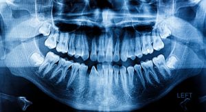 Dental digital x-ray image