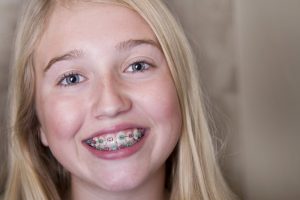 A smiling girl with traditional braces.