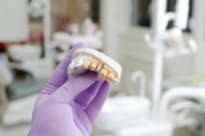 dental implants