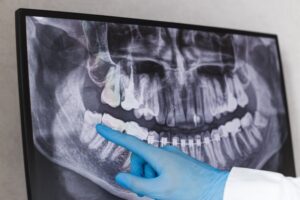 Dentist pointing to wisdom tooth on an X-ray