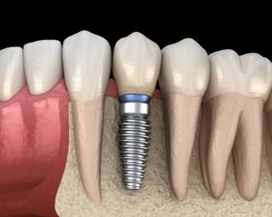 Model of dental implant