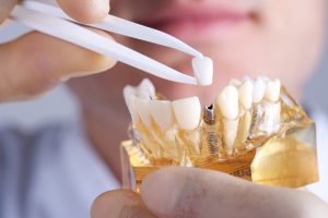 How can dental implants in Waco improve the quality of your life?