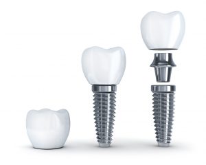 parts of a dental implant