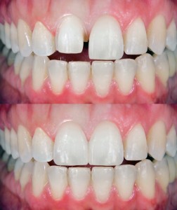 porcelain veneers in Waco