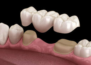 3D image of a dental bridge